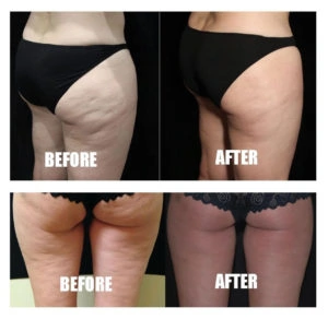 Cellulate-leg-before-after | Limitless Aesthetics & Wellness | Scottsdale, AZ