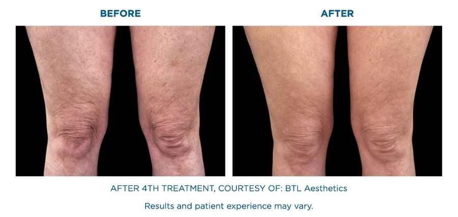 Cellulate-leg-before-after | Limitless Aesthetics & Wellness | Scottsdale, AZ