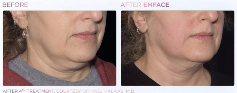 EmFace-women-lips-before-after | Limitless Aesthetics & Wellness | Scottsdale, AZ