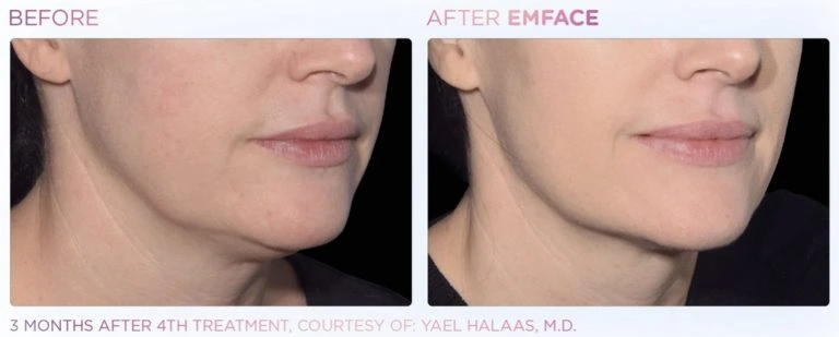 EmFace-lips-before-after | Limitless Aesthetics & Wellness | Scottsdale, AZ