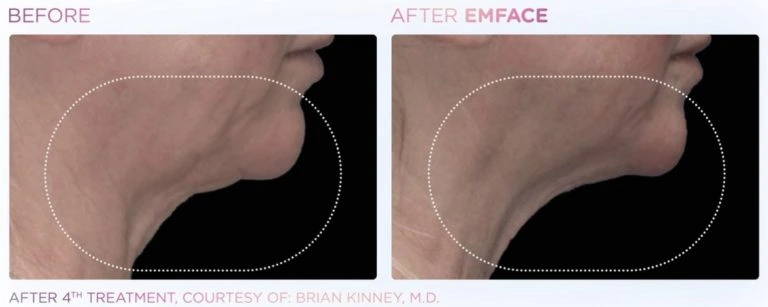 EmFace-old-women-before-after | Limitless Aesthetics & Wellness | Scottsdale, AZ