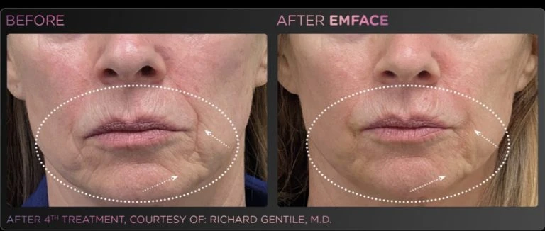 EmFace-women-lips-before-after | Limitless Aesthetics & Wellness | Scottsdale, AZ