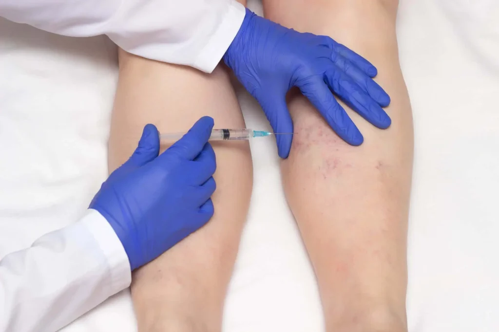 Sclerotherapy | Limitless Aesthetics & Wellness | Scottsdale, AZ