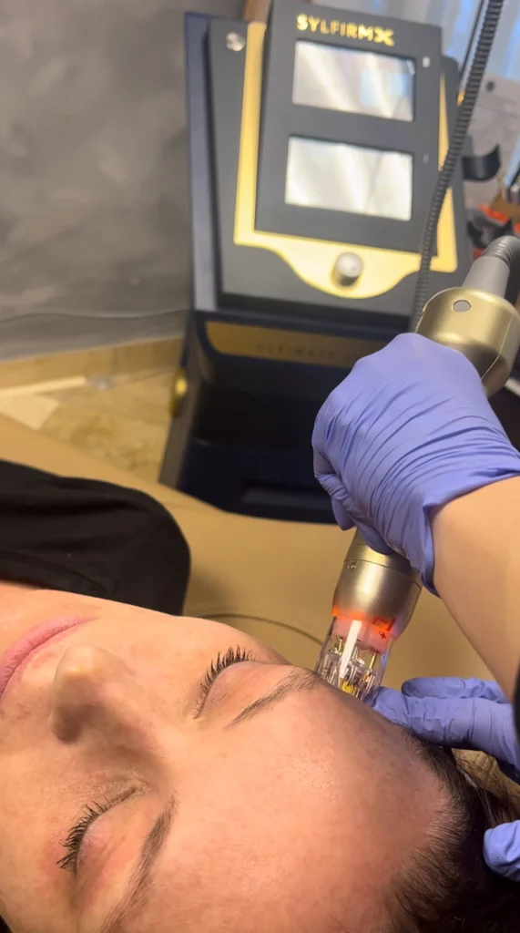 SylfirmX RF Microneedling Treatment | Limitless Aesthetics & Wellness | Scottsdale, AZ